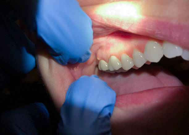 Best Emergency Gum Treatment in Raleigh, NC